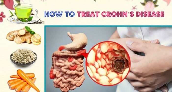 14 Self-Care Tips for Crohn's Disease
