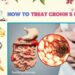14 Self-Care Tips for Crohn's Disease